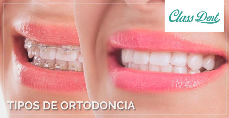 TIPOS DE ORTODONCIA | CLASS DENT